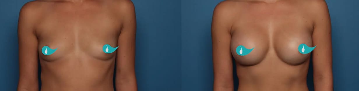 Before and After img